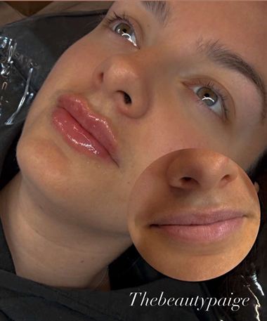 Lips after a filler treatment by Paige.