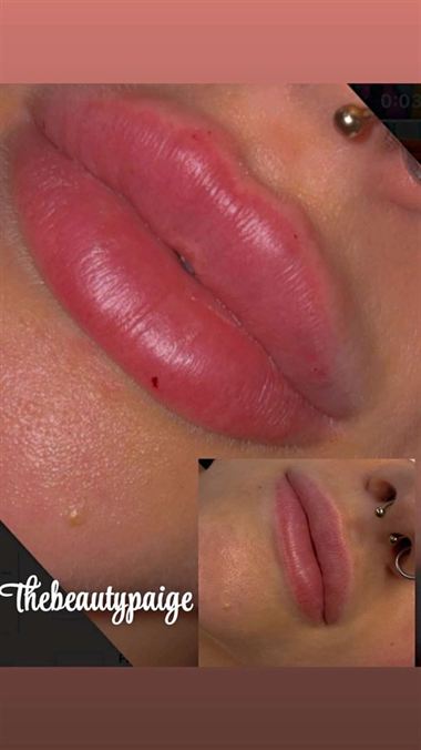 Lips after a filler treatment by Paige, close up.