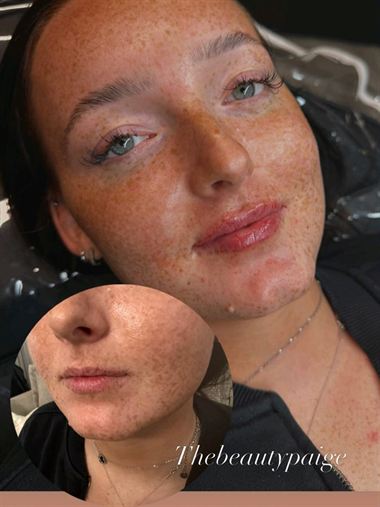 Lip filler results by Paige, with a before inset.